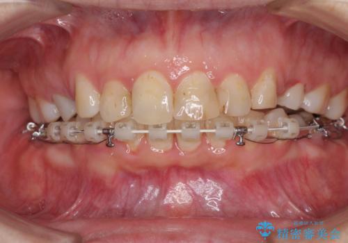 ハーフリンガルで歯列をきれいに セラミック治療で気になる銀歯も自然な色にの治療中