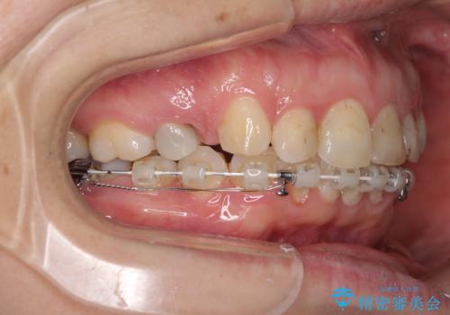 ハーフリンガルで歯列をきれいに　セラミック治療で気になる銀歯も自然な色にの治療中