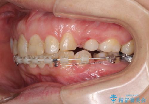 ハーフリンガルで歯列をきれいに セラミック治療で気になる銀歯も自然な色にの治療中