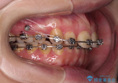 外科手術が必要と言えるほど突出した前歯 長期間をかけた抜歯矯正の治療中