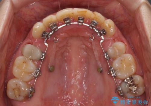 ハーフリンガルで歯列をきれいに セラミック治療で気になる銀歯も自然な色にの治療中