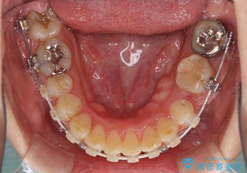 ハーフリンガルで歯列をきれいに セラミック治療で気になる銀歯も自然な色にの治療中