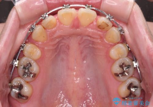 外科手術が必要と言えるほど突出した前歯　長期間をかけた抜歯矯正の治療中
