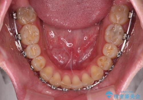 外科手術が必要と言えるほど突出した前歯　長期間をかけた抜歯矯正の治療中