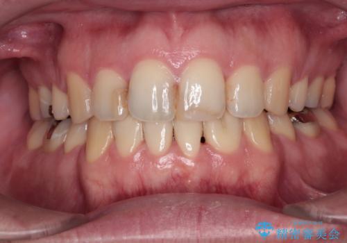 しゃくれて口が閉じられない ワイヤー装置での抜歯矯正の治療後