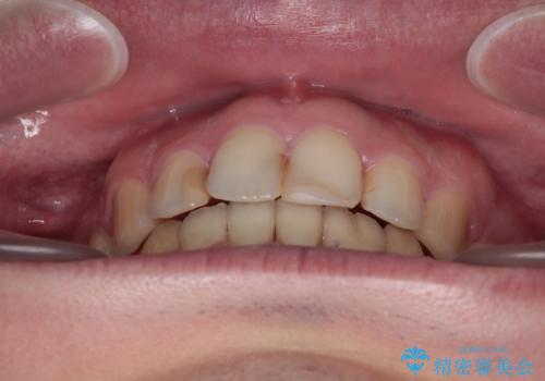 しゃくれて口が閉じられない ワイヤー装置での抜歯矯正の治療後