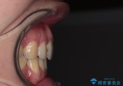 しゃくれて口が閉じられない ワイヤー装置での抜歯矯正の治療後