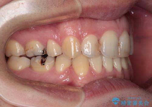 しゃくれて口が閉じられない ワイヤー装置での抜歯矯正の治療後