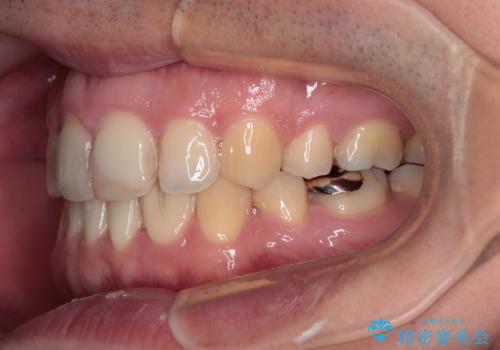しゃくれて口が閉じられない ワイヤー装置での抜歯矯正の治療後