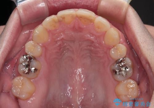 しゃくれて口が閉じられない ワイヤー装置での抜歯矯正の治療後