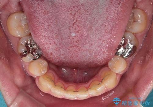 しゃくれて口が閉じられない ワイヤー装置での抜歯矯正の治療後