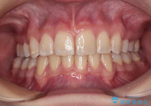 【モニター】出っ歯と八重歯　抜歯矯正でスッキリとした口元にの症例 治療後