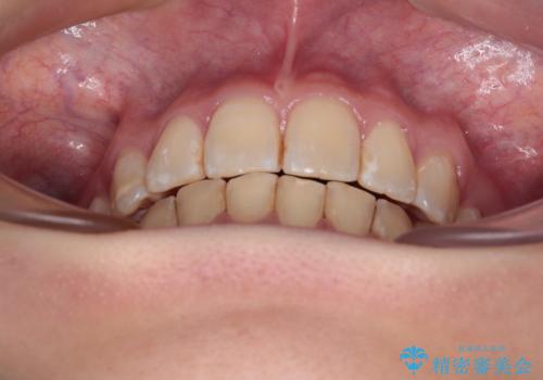 【モニター】出っ歯と八重歯　抜歯矯正でスッキリとした口元にの治療後
