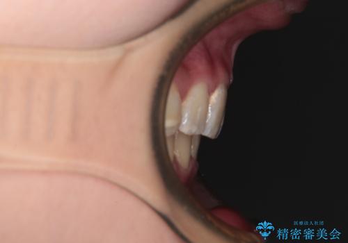 【モニター】出っ歯と八重歯 抜歯矯正でスッキリとした口元にの治療後