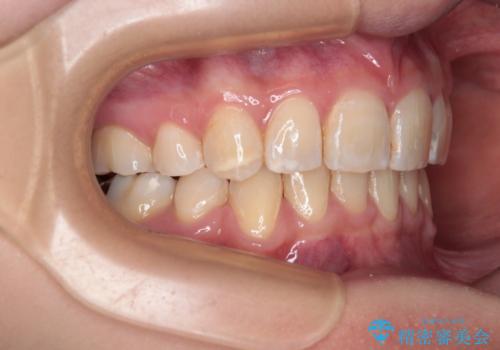 【モニター】出っ歯と八重歯 抜歯矯正でスッキリとした口元にの治療後