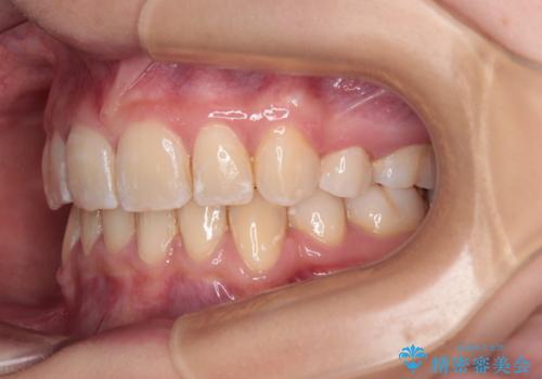 【モニター】出っ歯と八重歯 抜歯矯正でスッキリとした口元にの治療後