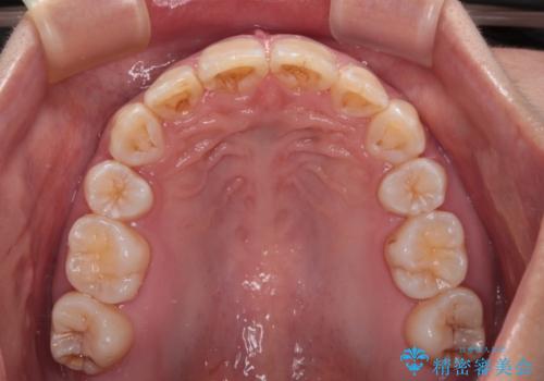 【モニター】出っ歯と八重歯 抜歯矯正でスッキリとした口元にの治療後