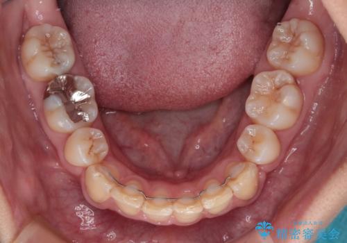 【モニター】出っ歯と八重歯 抜歯矯正でスッキリとした口元にの治療後