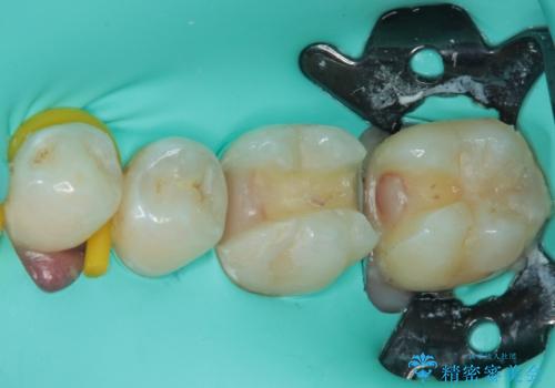 奥歯がしみる 保険の詰め物をセラミックインレーにの治療中