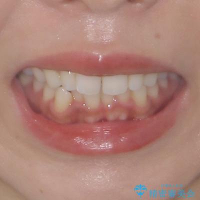 唇が閉じにくい ワイヤー装置での抜歯矯正の治療前(顔貌)