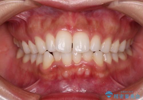 唇が閉じにくい　ワイヤー装置での抜歯矯正の症例 治療前