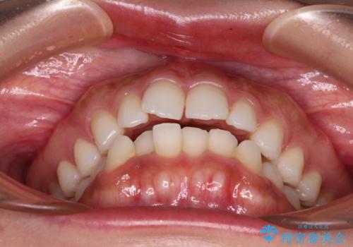 唇が閉じにくい ワイヤー装置での抜歯矯正の治療前