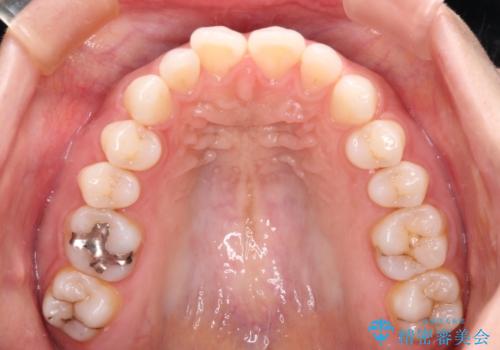 唇が閉じにくい ワイヤー装置での抜歯矯正の治療前