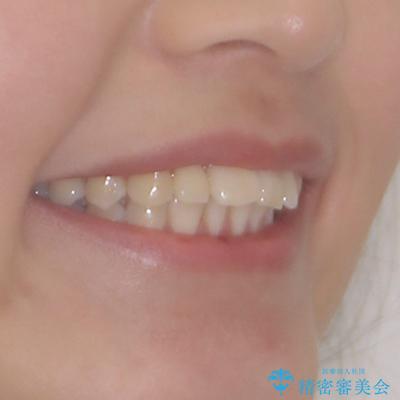 飛び出した前歯を引っ込めたい ワイヤー装置での抜歯矯正の治療前(顔貌)