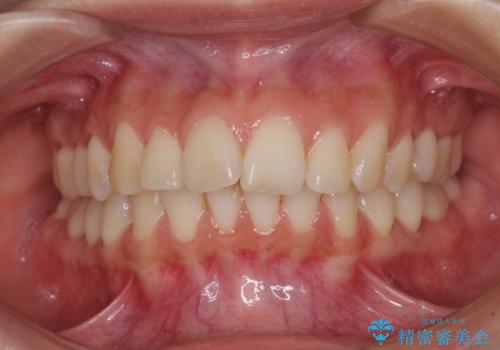 飛び出した前歯を引っ込めたい ワイヤー装置での抜歯矯正の症例 治療前