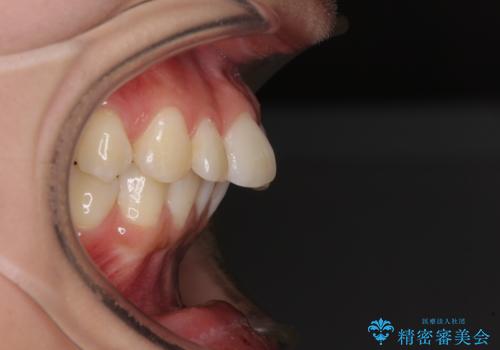 飛び出した前歯を引っ込めたい ワイヤー装置での抜歯矯正の治療前