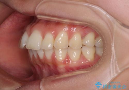 飛び出した前歯を引っ込めたい ワイヤー装置での抜歯矯正の治療前