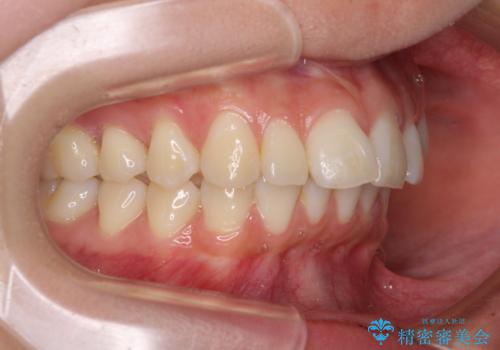 飛び出した前歯を引っ込めたい ワイヤー装置での抜歯矯正の治療前