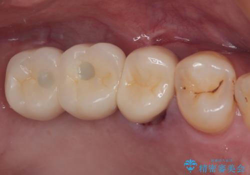 奥歯の欠損部　インプラント補綴治療の症例 治療後