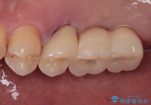 奥歯の欠損部　インプラント補綴治療の治療後
