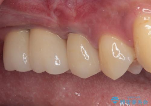 奥歯の欠損部　インプラント補綴治療