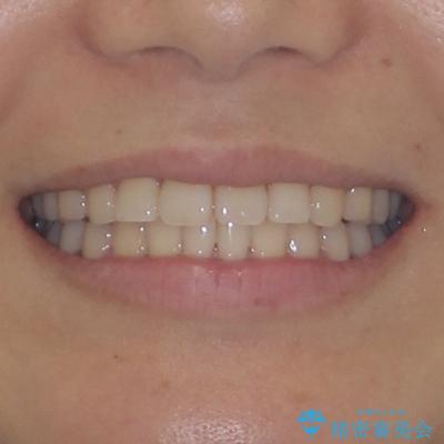 上下前歯のデコボコ ワイヤー装置で楽して改善の治療後(顔貌)
