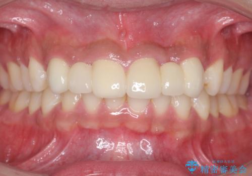 前歯のすきま 生まれつき歯が少ないのを治療の治療後