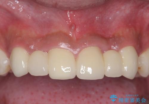 前歯のすきま 生まれつき歯が少ないのを治療の治療後