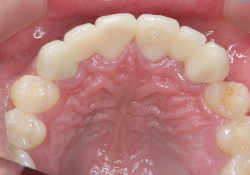 前歯のすきま　生まれつき歯が少ないのを治療の治療後