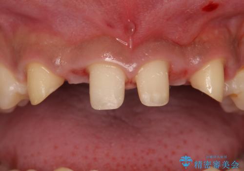 前歯のすきま　生まれつき歯が少ないのを治療の治療中