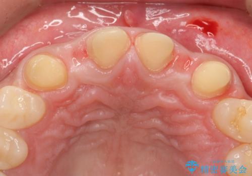 前歯のすきま 生まれつき歯が少ないのを治療の治療中