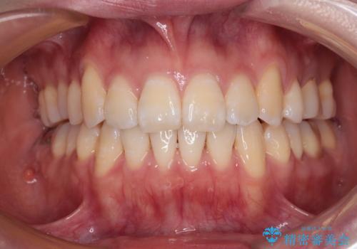 八重歯と開咬の抜歯矯正　ワイヤー装置を併用したインビザライン矯正治療の症例 治療後