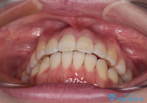 八重歯と開咬の抜歯矯正 ワイヤー装置を併用したインビザライン矯正治療の治療後