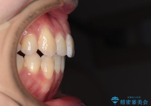 八重歯と開咬の抜歯矯正　ワイヤー装置を併用したインビザライン矯正治療の治療後