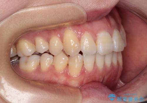 八重歯と開咬の抜歯矯正　ワイヤー装置を併用したインビザライン矯正治療の治療後