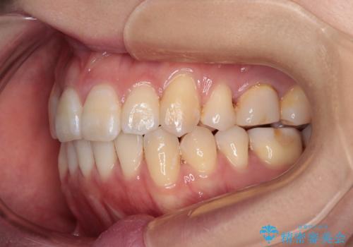 八重歯と開咬の抜歯矯正 ワイヤー装置を併用したインビザライン矯正治療の治療後
