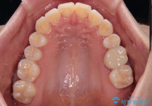 八重歯と開咬の抜歯矯正 ワイヤー装置を併用したインビザライン矯正治療の治療後