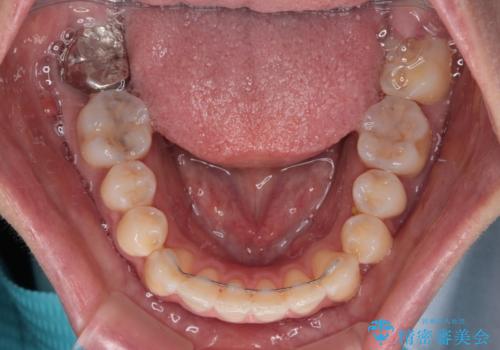 八重歯と開咬の抜歯矯正 ワイヤー装置を併用したインビザライン矯正治療の治療後