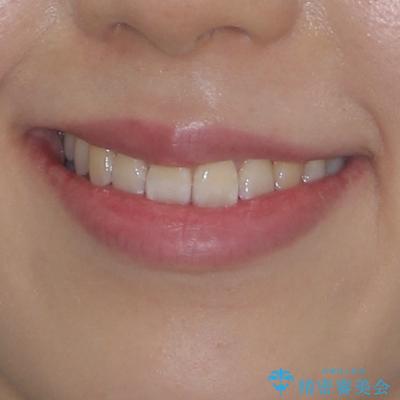 八重歯と開咬の抜歯矯正 ワイヤー装置を併用したインビザライン矯正治療の治療後(顔貌)