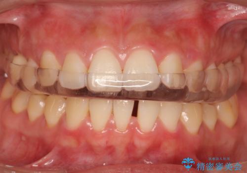 ナイトガードで歯ぎしりの影響を抑えるの治療後